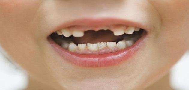 9 2586.jpg672a1c200ff4c - الأسنان الأمامية تفسير حلم سقوط الاسنان